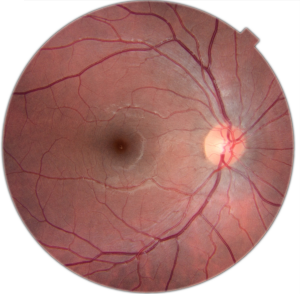 File:Human eye with blood vessels.jpg - Wikipedia